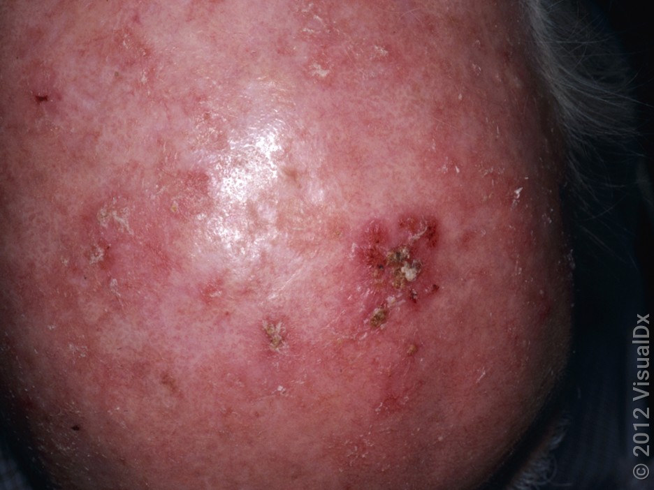 Squamous Cell Carcinoma - Scalp Guardian