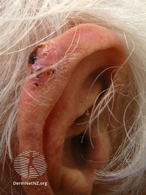 squamous cell carcinoma in situ right inferior parietal scalp icd 10